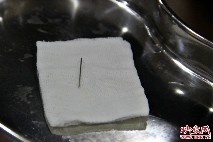 上午11點(diǎn)30分許，小龍腦中鋼針已經(jīng)成功取出。