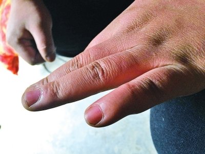 哥為給弟看病無(wú)錢(qián)支付彩禮 夫妻吵架自殘剁手指