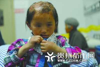 被燙傷的頭皮一直沒有愈合。