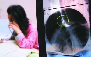 假牙上的鋼絲刺破食管，而薄薄的食道壁緊貼主動脈血管，極易造成血管破裂