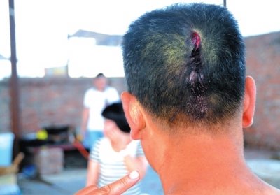 崔先生頭部受傷。京華時報記者趙思衡攝/視頻