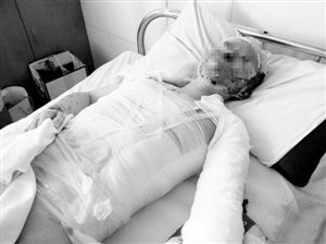 周小姐的頭、頸、軀干、四肢均被燒傷，其中面部燒傷最為嚴(yán)重。