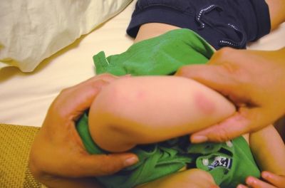 孩子身上有多處明顯傷痕。京華時報讀者供圖