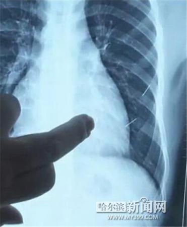 17歲少年體內扎進4根鋼針 1根已插入心臟4厘米
