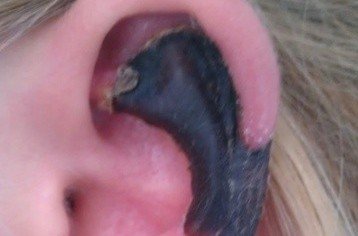 荷蘭女子旅游途中被蜘蛛咬，耳軟骨溶解變黑。