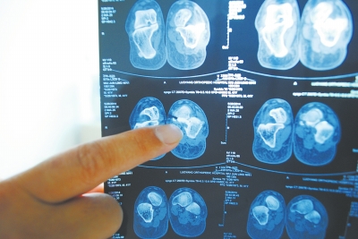 X光片顯示,確實(shí)有一根殘留的螺絲釘。