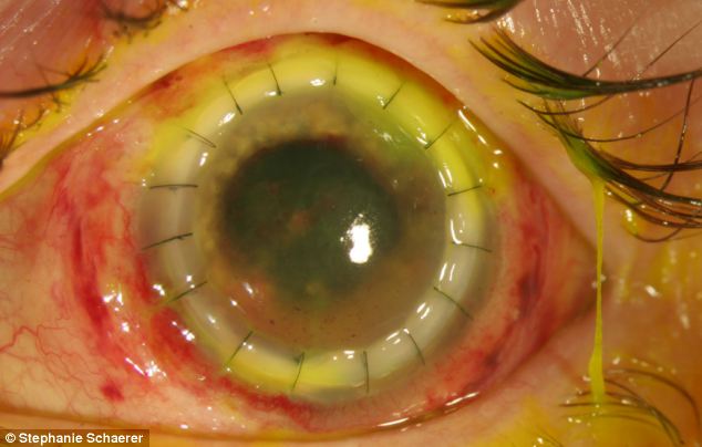 恐怖慎入！隱形眼鏡致英女子摘除眼球