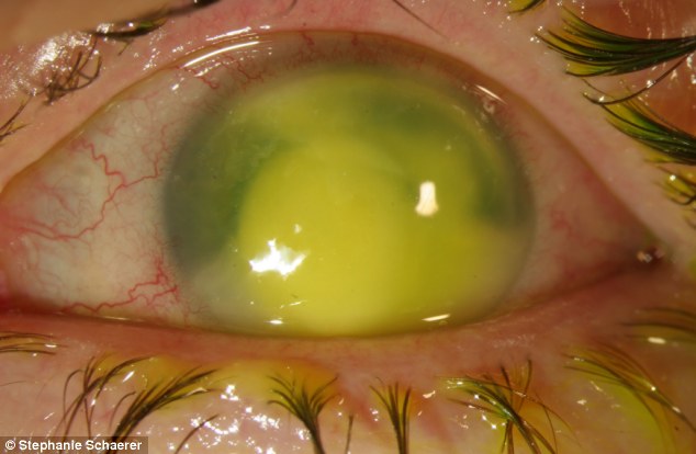 恐怖慎入！隱形眼鏡致英女子摘除眼球