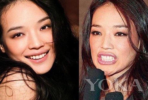 牙齒凸出，口輪肌過于松弛