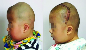 術(shù)前（左），術(shù)后（右）