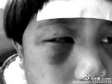 6月2日，網(wǎng)曝渭南市臨渭區(qū)一不滿5歲的女童遭奶奶毆打，眼圈青腫，引起網(wǎng)友關注，但孩子父母和爺爺均稱是摔倒導致。相關部門介入調查發(fā)現(xiàn)確為奶奶毆打所致，鑒于其身體原因已進行批評教育。