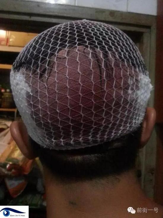 李律師受傷后縫合三針。