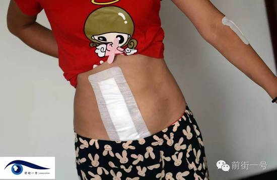 小金腹部的傷口。