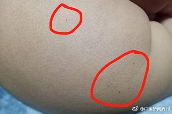 據(jù)多名紅黃藍(新天地分園)家長反映，孩子腿部、屁股、腋下出現(xiàn)針眼。