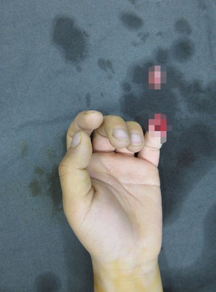 嚇哭！6歲男孩被夾斷手指 罪魁禍首竟是校服