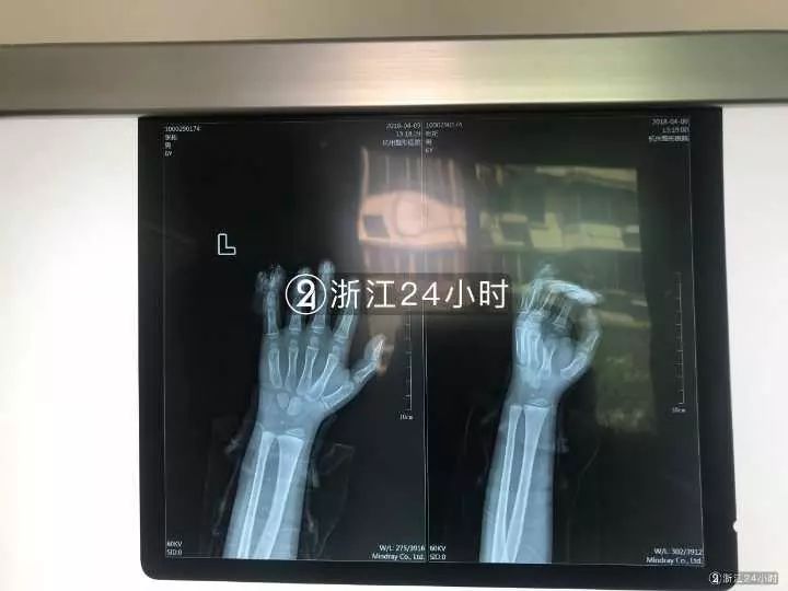 嚇哭！6歲男孩被夾斷手指 罪魁禍首竟是校服