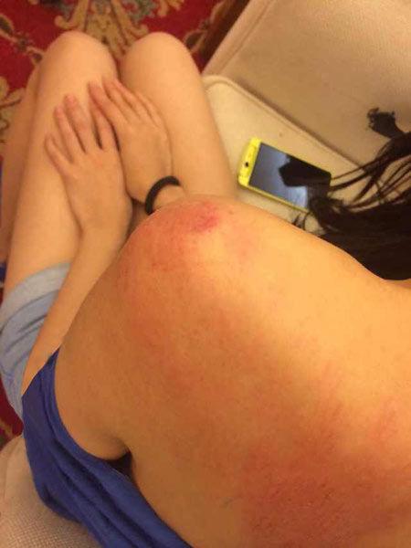 “跑男”真的很拼！baby朋友圈曬后背紅腫照