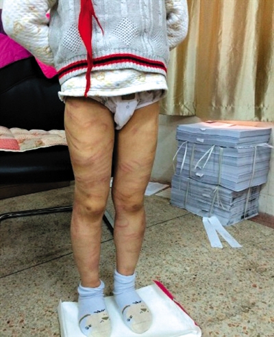 4月3日晚，微博網(wǎng)友“@朝廷半日閑”發(fā)圖文微博展示男童被虐待的慘狀。 微博截圖