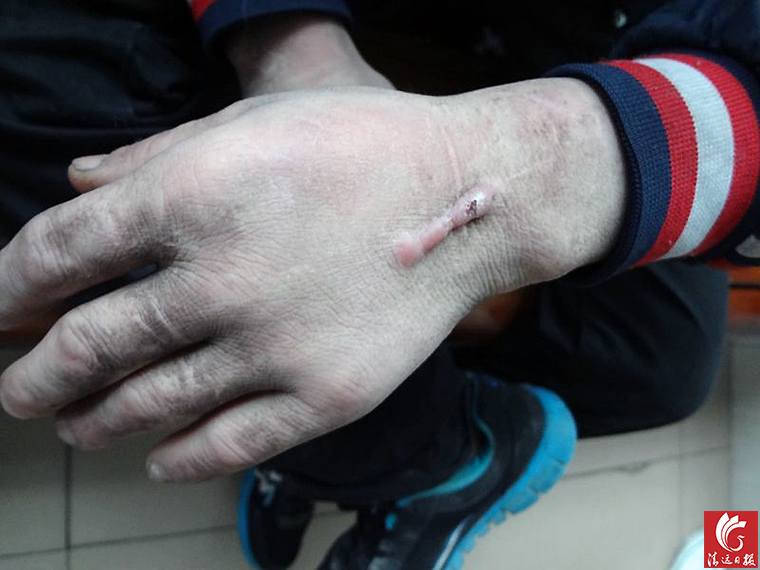 被發(fā)現(xiàn)男子手上的傷疤。