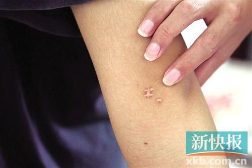 取出針后李星兒手臂留下了傷口。新快報(bào)記者 張國(guó)鋒/攝