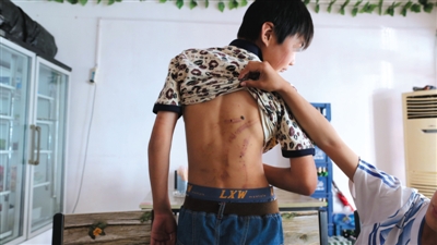 　昨日，奶西村，被打的小剛后背上條條瘀痕依然明顯。