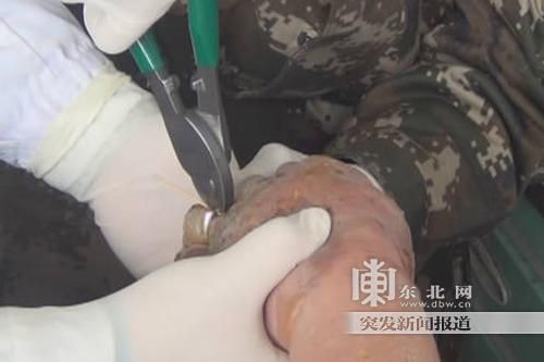 正在拆除戒指。