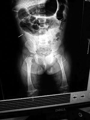 目前體內(nèi)的12根鋼針多分布在孩子的臀部，一根在腹部，其余3根在胸腔附近，其中一根很接近心臟