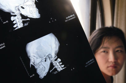 國內(nèi)醫(yī)院CT顯示，如今靳魏坤的鼻子假體是歪的，連下巴也是歪的