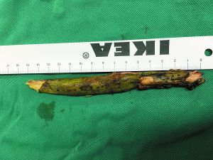 插入男子腦內(nèi)的樹枝。