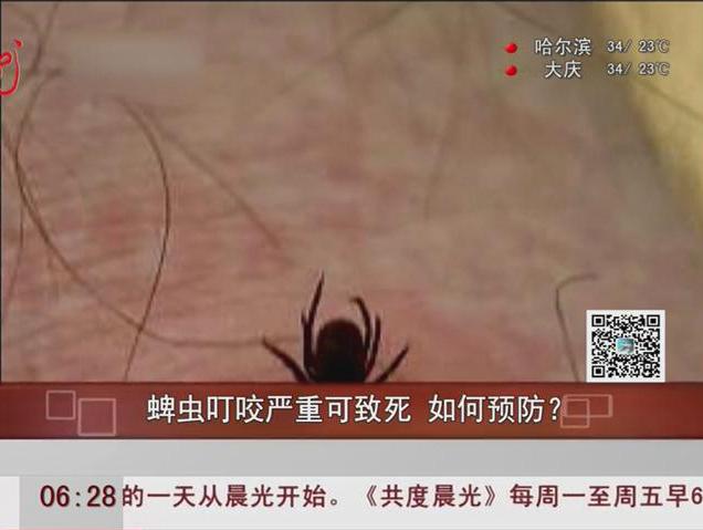 蜱蟲叮咬嚴重可致死如何預防？